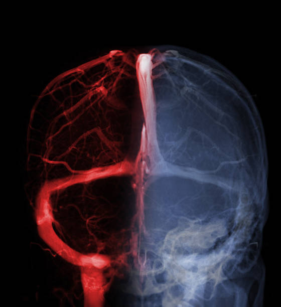 zerebrale venographie zur diagnose zerebrale venenthrombose - scandic stock-fotos und bilder