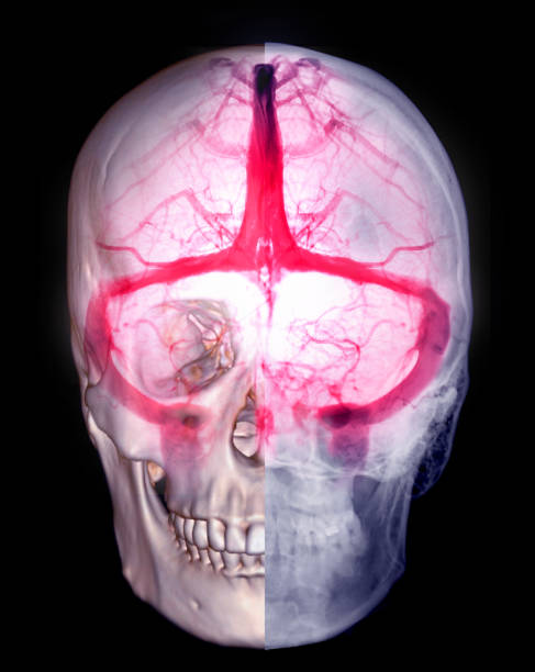 zerebrale venographie zur diagnose zerebrale venenthrombose - scandic stock-fotos und bilder