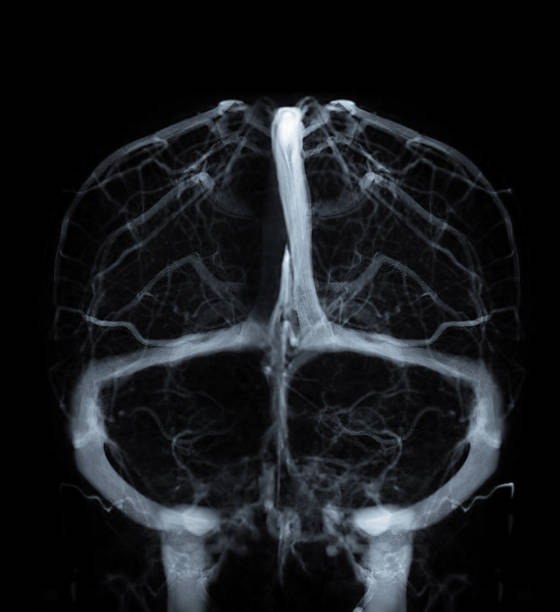 zerebrale venographie zur diagnose zerebrale venenthrombose - scandic stock-fotos und bilder