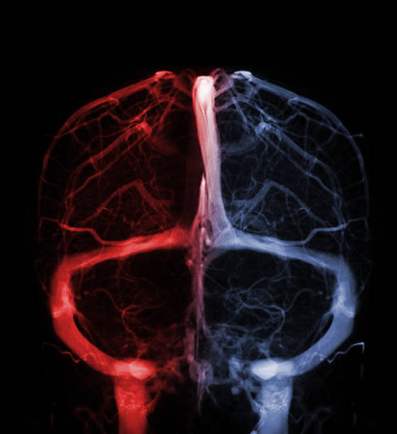 zerebrale venographie zur diagnose zerebrale venenthrombose - scandic stock-fotos und bilder