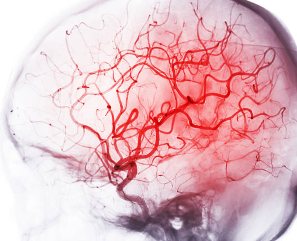 obraz angiografii mózgowej z fluoroscopy w radiologii interwencyjnej pokazujący tętnicę mózgową. - cyrkulacja zdjęcia i obrazy z banku zdjęć