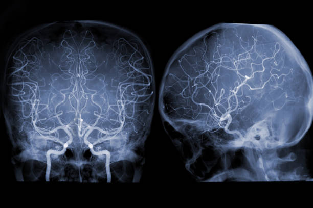 Cerebral angiography  image from Fluoroscopy in intervention radiology  showing cerebral artery. Cerebral angiography  image from Fluoroscopy in intervention radiology  showing cerebral artery. arterioles photos stock pictures, royalty-free photos & images