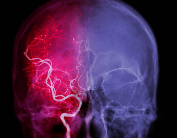 Cerebral angiography  image from Fluoroscopy in intervention radiology  showing cerebral artery. Cerebral angiography  image from Fluoroscopy in intervention radiology  showing cerebral artery. arterioles photos stock pictures, royalty-free photos & images