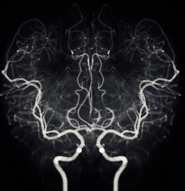 Cerebral angiography  image from Fluoroscopy in intervention radiology  showing cerebral artery. stock photo