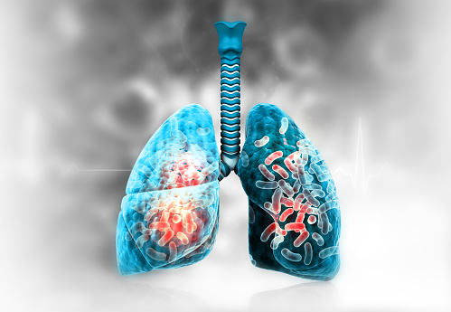Human lungs bacterial virus infection. 3d illustration