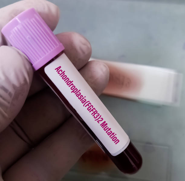 próbka krwi pełnej dla achondroplazji (fgfr3) 2 test mutacji do diagnozy achondroplazji. - achondroplazja obrazy zdjęcia i obrazy z banku zdjęć
