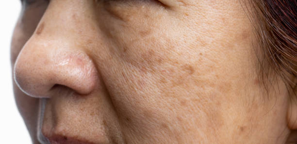 istock Menopausal women worry about melasma on face. 1473625424