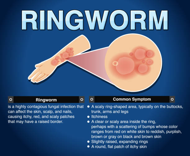 ilustrações de stock, clip art, desenhos animados e ícones de informative poster of ringworm - frieiras