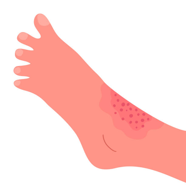dermatitis auf der haut eines menschlichen beines - toxicodermatitis stock-grafiken, -clipart, -cartoons und -symbole