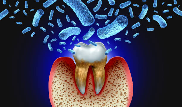 Bacterial Tooth Infection stock photo