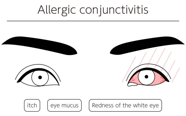 Medical Clipart, Line Drawing Illustration of Eye Disease and Allergic conjunctivitis Medical Clipart, Line Drawing Illustration of Eye Disease and Allergic conjunctivitis human eye scratching allergy rubbing stock illustrations