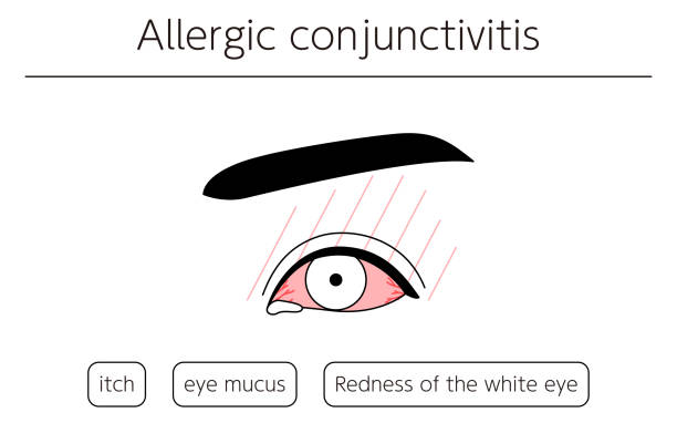 Medical Clipart, Line Drawing Illustration of Eye Disease and Allergic conjunctivitis Medical Clipart, Line Drawing Illustration of Eye Disease and Allergic conjunctivitis human eye scratching allergy rubbing stock illustrations