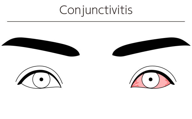 Medical Clipart, Line Drawing Illustration of Eye Disease and Conjunctivitis Medical Clipart, Line Drawing Illustration of Eye Disease and Conjunctivitis human eye scratching allergy rubbing stock illustrations