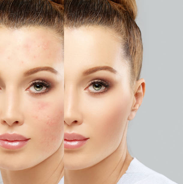 istock Post-Acne Marks /Treating Acne Scars 1473962872