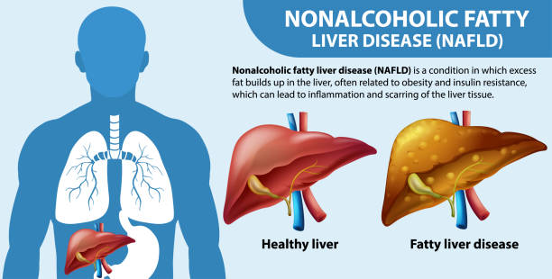 illustrazioni stock, clip art, cartoni animati e icone di tendenza di steatosi epatica non alcolica (nafld) - insulin resistance