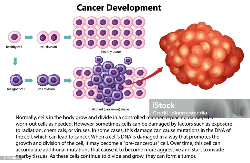 Cancer Development Published Cancer Development Vector With Information Stock Illustration ...