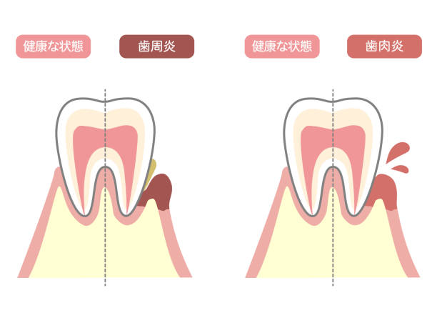 ilustracja zdrowych zębów, chorób przyzębia i zapalenia dziąseł - human teeth gums dental hygiene inflammation stock illustrations