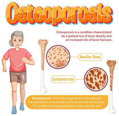 Poster Informatif Osteoporosis Tulang Manusia Ilustrasi Stok Biology Diagrams
