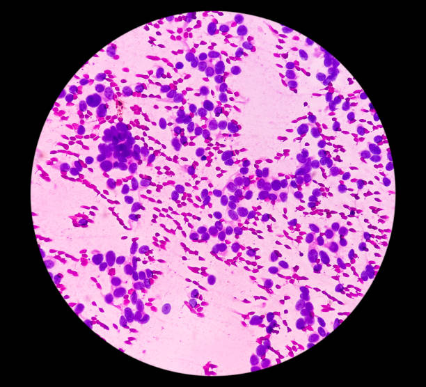 usg руководствуется fna цитологией из печени sol. неходжкинская лимфома. мазок показывает атипичные мелкие круглые клетки и воспалительные кле - cancer cell flash стоковые фото и изображения