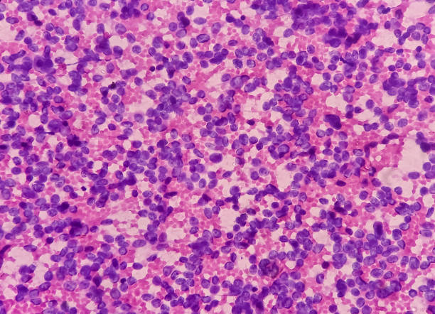 usg guided fna cytology from liver sol. non-hodgkin lymphoma. smear show atypical small round cells and inflammatory cells and blood background. metastatic carcinoma. - non hodgkin lymphoma imagens e fotografias de stock
