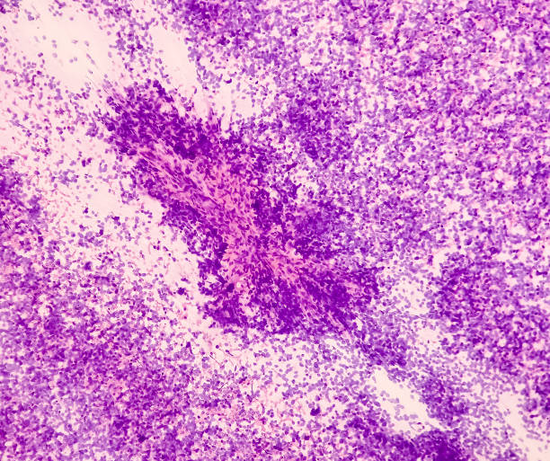 usg руководствуется fna цитологией из печени sol. неходжкинская лимфома. мазок показывает атипичные мелкие круглые клетки и воспалительные кле - cancer cell flash стоковые фото и изображения