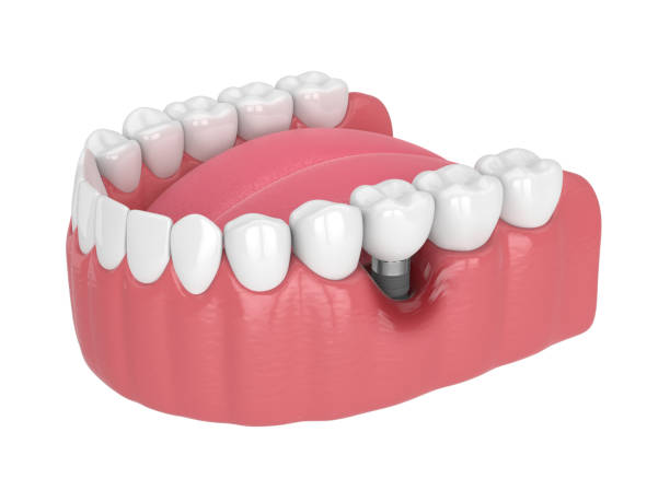 istock 3d render of human jaw with peri implantitis disease 1474106601