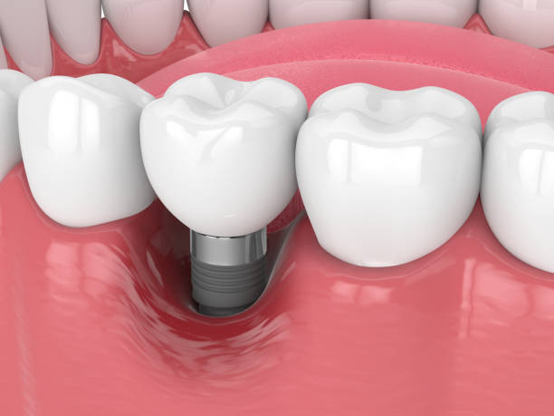 istock 3d render of human jaw with peri implantitis disease 1474106745