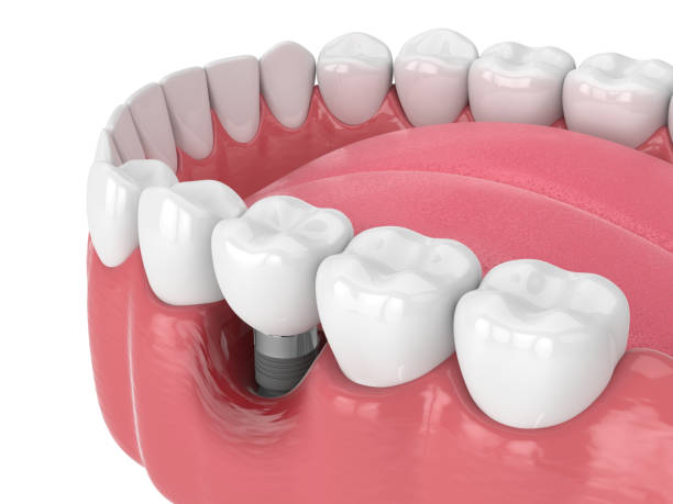 istock 3d render of human jaw with peri implantitis disease 1474106771