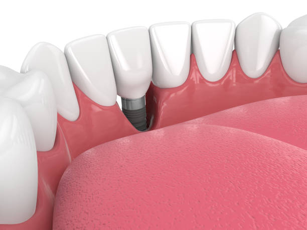 istock 3d render of human jaw with peri implantitis disease 1474107742