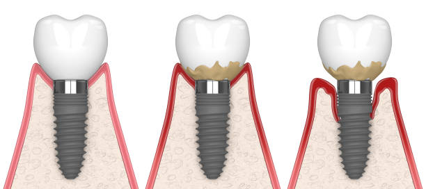 3d render of human gums cross-section with peri implantitis disease stock photo