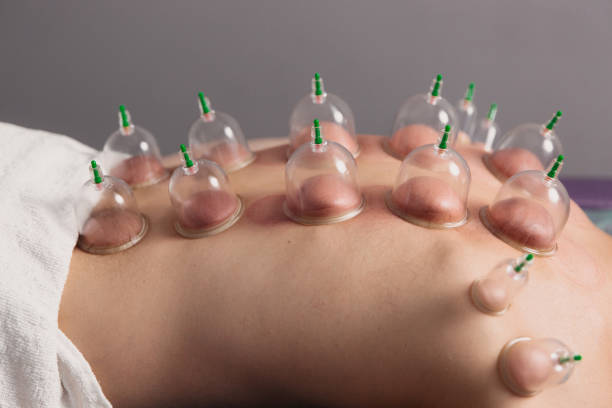 istock Banks for massage on the man's back. Massage with vacuum cups. 1474210557