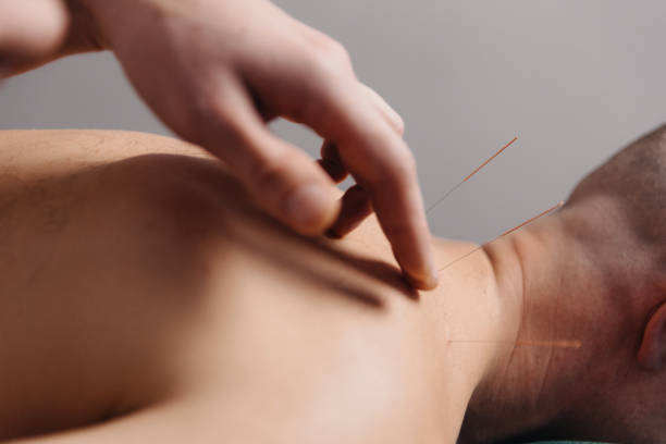 istock Side view of young man undergoing acupuncture treatment in spa 1474210954