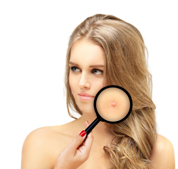 istock Post-Acne Marks /Treating Acne Scars 1474400028