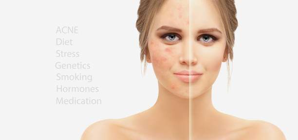 Post-Acne Marks /Treating Acne Scars.Acne Scar Removal stock photo Post-Acne Marks /Treating Acne Scars.Acne Scar Removal stock photo