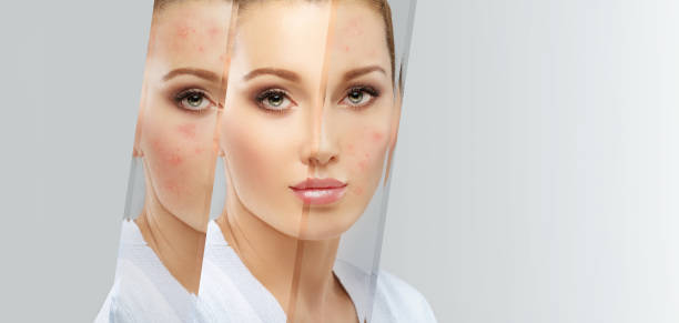istock Post-Acne Marks /Treating Acne Scars 1474400273
