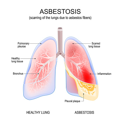 asbestosis lungs. Inflammation and scarring of the lungs due to asbestos fibers. cancer. Vector illustration