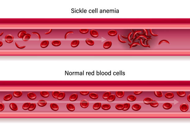 diagramm des vergleichs blutfluss zwischen sichelzellenanämie und normalen blutgefäßen. - sickle cell anemia red blood cell blood cell anemia stock-grafiken, -clipart, -cartoons und -symbole