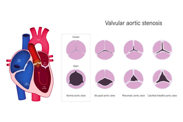 клапанный стеноз аорты. нормальный аортальный клапан, двустворчатый аортальный клапан, ревматический аортальный клапан и кальцинированны - premolar stock illustrations