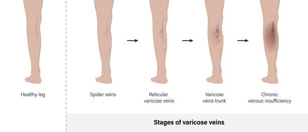 illustrations, cliparts, dessins animés et icônes de stade des varices. varices dans le vecteur de la jambe humaine. - venous insufficiency