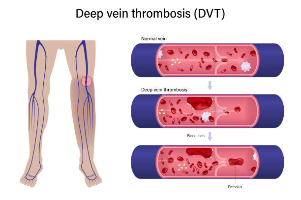 illustrations, cliparts, dessins animés et icônes de diagramme des jambes avec des images agrandies des veines normales et de la thrombose veineuse profonde. vecteurs à utiliser dans les études scientifiques et médicales. - venous insufficiency