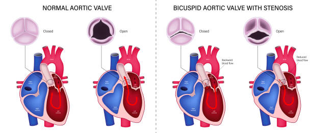 ilustraciones, imágenes clip art, dibujos animados e iconos de stock de la diferencia de la válvula aórtica normal y la válvula aórtica bicúspide con estenosis. estenosis aórtica valvular. vector de anatomía cardíaca. primer plano de las válvulas aórticas normales y anormales. - premolar