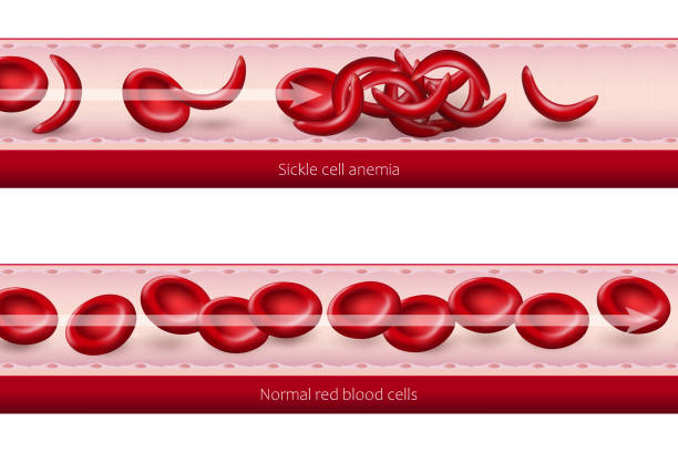 ilustraciones, imágenes clip art, dibujos animados e iconos de stock de comparación del flujo sanguíneo de la anemia de células falciformes con glóbulos rojos normales. enfermedad de células falciformes. - sickle cell anemia red blood cell blood cell anemia