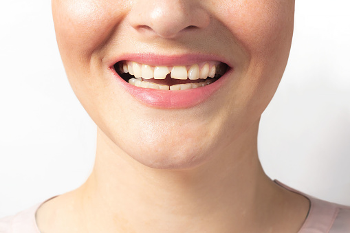 Woman shows broken tooth. Close up photo. Need a dentist