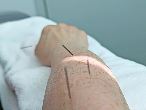 Four acupuncture needles help reduce chronic pain related to tennis elbow or lateral epicondylitis in a senior woman's arm. Treatment in British Columbia, Canada.