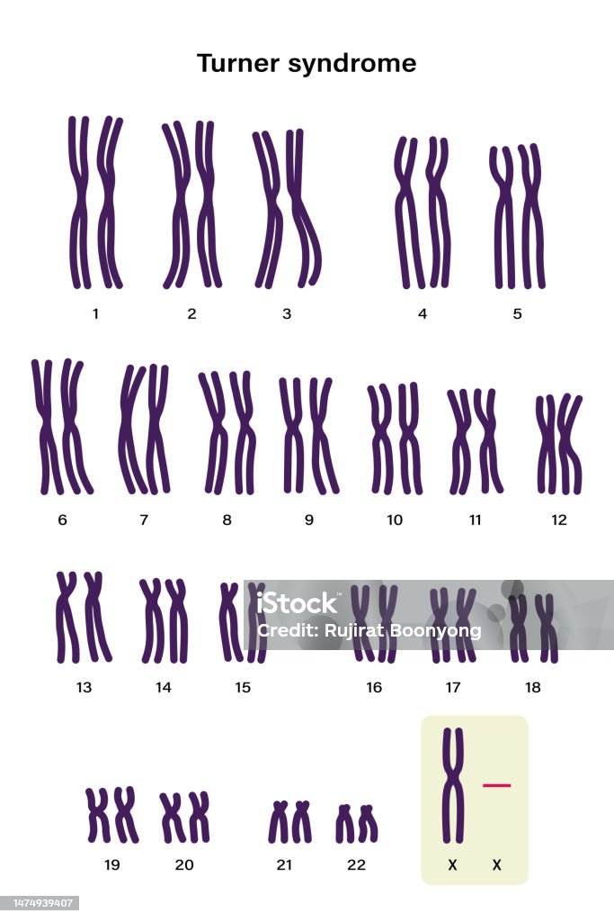 Cariotipo humano del síndrome de Turner. Uno de los cromosomas X (cromosomas sexuales) falta o falta parcialmente. 45,X o 45,X0 - arte vectorial de ADN libre de derechos