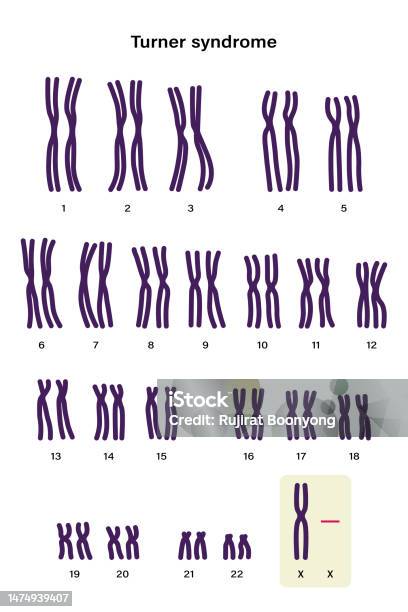Ilustración de Cariotipo Humano Del Síndrome De Turner Uno De Los Cromosomas X Falta O Falta Parcialmente 45 X O 45 X0 y más Vectores Libres de Derechos de ADN