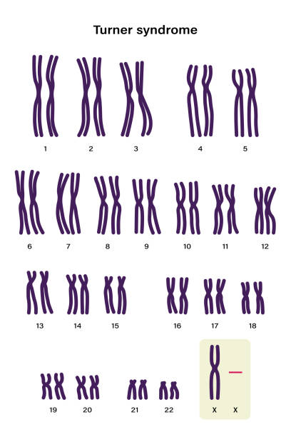 ターナー症候群のヒト核型。x染色体の1つ(性染色体)が欠けているか、部分的に欠けている。45、x、または45,x0 - symbol sex healthcare and medicine healthy lifestyle点のイラスト素材／クリップアート素材／マンガ素材／アイコン素材