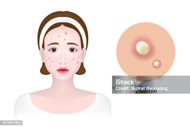 Pustule Remove Women And Pustule Acne Skin Problem Vector Stock Illustration ...