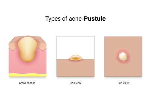 Pustules In The Skin Types Of Acne Skin Problems Pustule In Cross Section Side View And Top ...