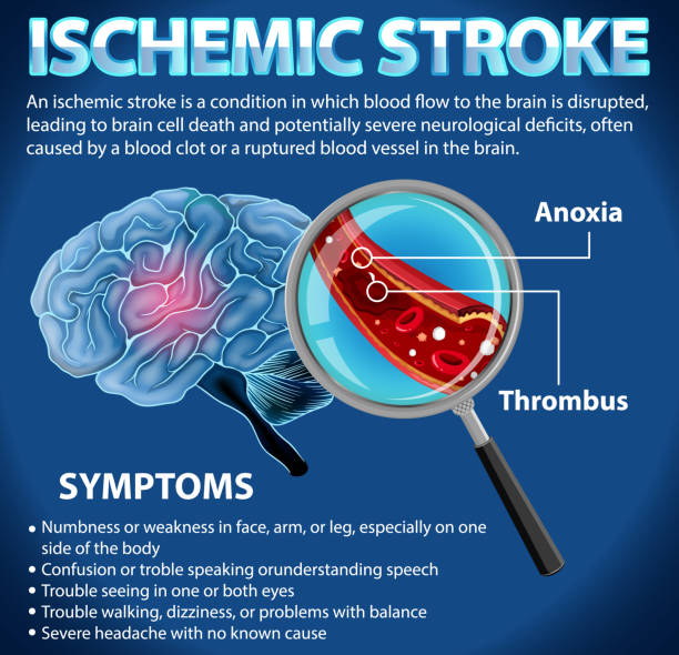 информативный плакат об ишемическом инсульте - anoxia stock illustrations